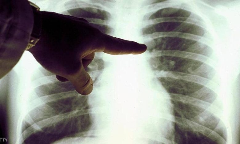 لقاح كورونا ومرضى سرطان الثدي.. "علامة" تقلق النساء 1 1 1286929