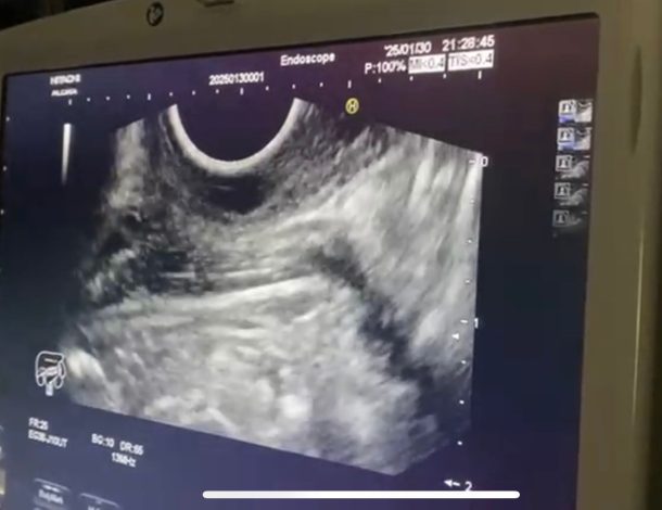 طب حلوان تُجري أول عملية منظار موجات فوق صوتية واستئصال ورم بالمريء في جلسة واحدة 4 almomken.com 63rEkV5k