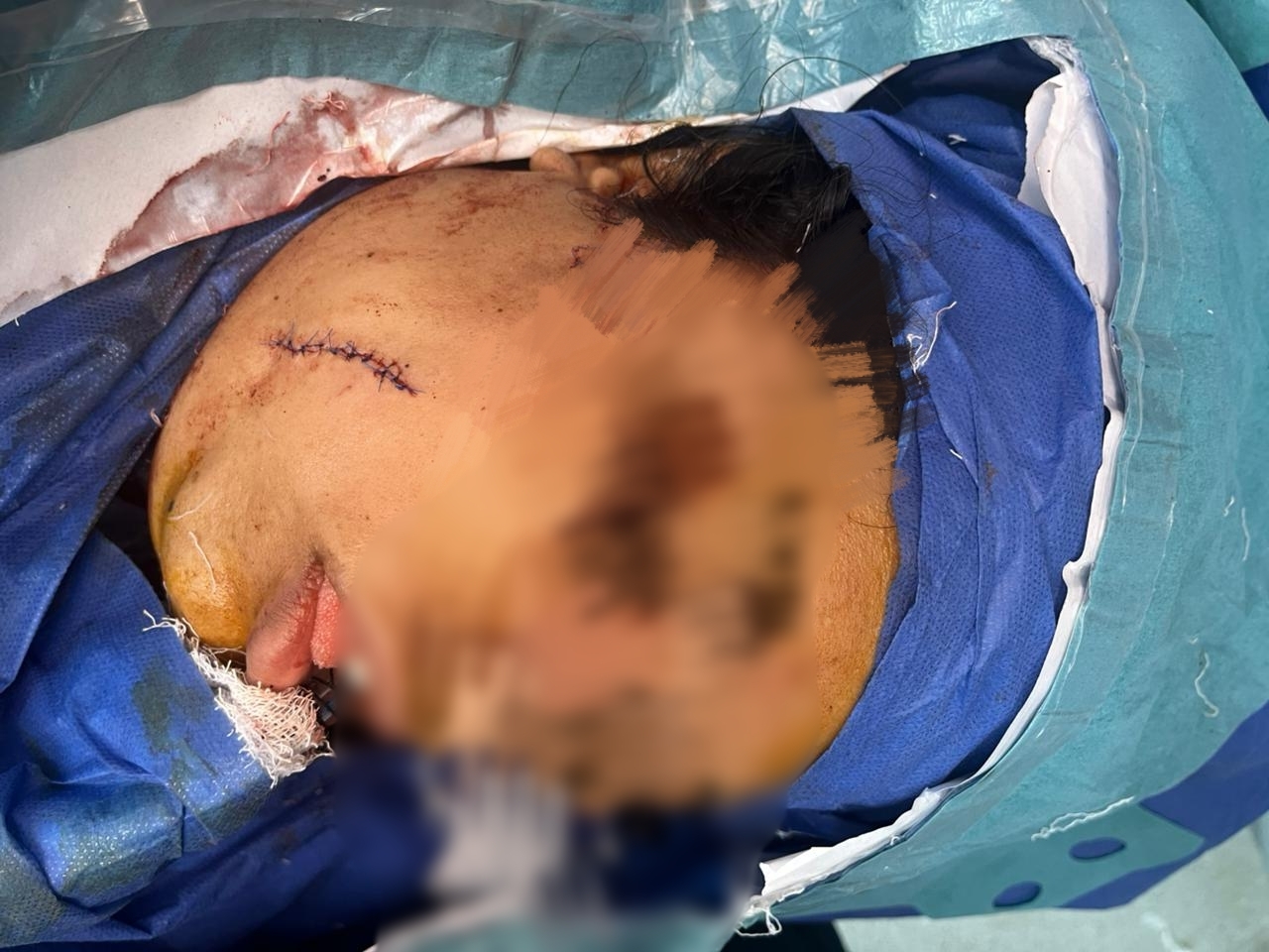 الفريق نجح  في استخراج السكين مع الحفاظ على أعصاب وعضلات الوجه
